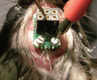 脑电螺钉插图 脑电螺钉插图